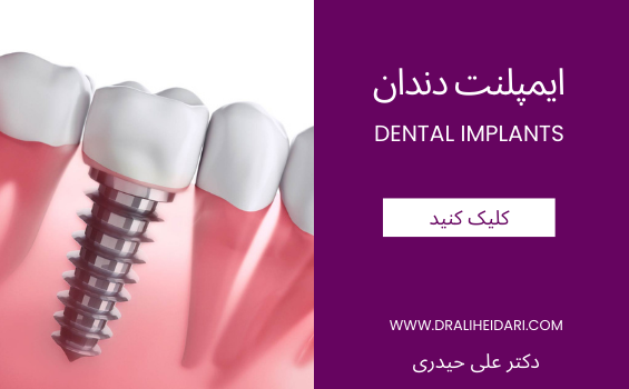 ایمپلنت دندان