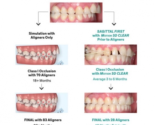 ارتودنسی کریر موشن