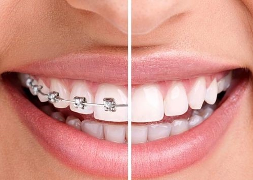 مراحل ارتودنسی به ترتیب