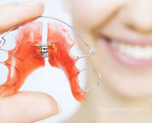 ارتودنسی متحرک چیست