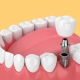 توصیه های قبل از ایمپلنت دندان